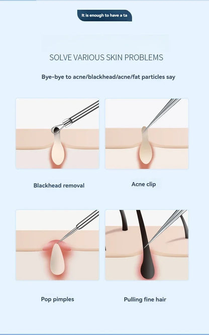 11Pcs/Set Acne Needle Blackhead Clip Remover Extraction Pore Black Head Cleaner Face Skin Care Cleansing Needle Tool Cell Clamp