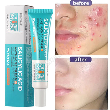 Salicylic Acid Acne Treatment Cream – Anti-Acne & Pimple Scar Repair Gel, Shrink Pores, Moisturizing & Smoothing Skin Care