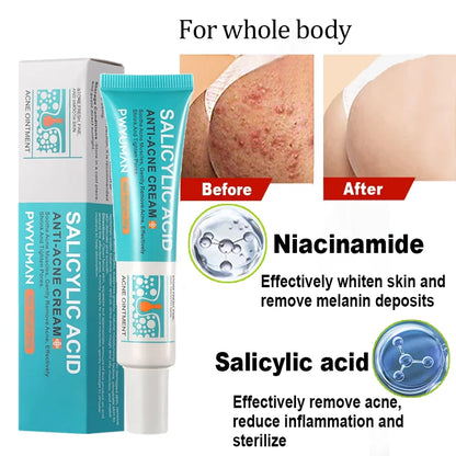 Salicylic Acid Acne Treatment Cream – Anti-Acne & Pimple Scar Repair Gel, Shrink Pores, Moisturizing & Smoothing Skin Care