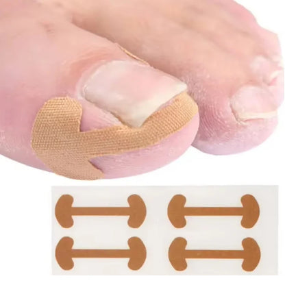 20-100pcs Adhesive Toenail Patch Ingrown Toe Nail Correction Sticker Foot Corrector Pedicure Health Care Tools Toe Treatment Pad