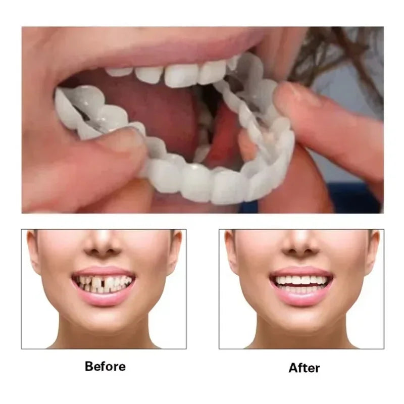 Snap-on Teeth Veneers Braces Box Kit, Snap-on Fake Teeth Veneers Braces Box Teeth Whitening Dental Care for Adults