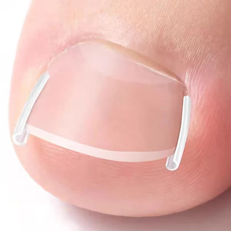 50Pcs Ingrown Toenail Correction Tool Invisible Ingrown Toe Nail Treatment Pad Groove Straightening Clip Brace Foot Care Tool