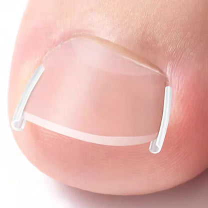 50Pcs Ingrown Toenail Correction Tool Invisible Ingrown Toe Nail Treatment Pad Groove Straightening Clip Brace Foot Care Tool