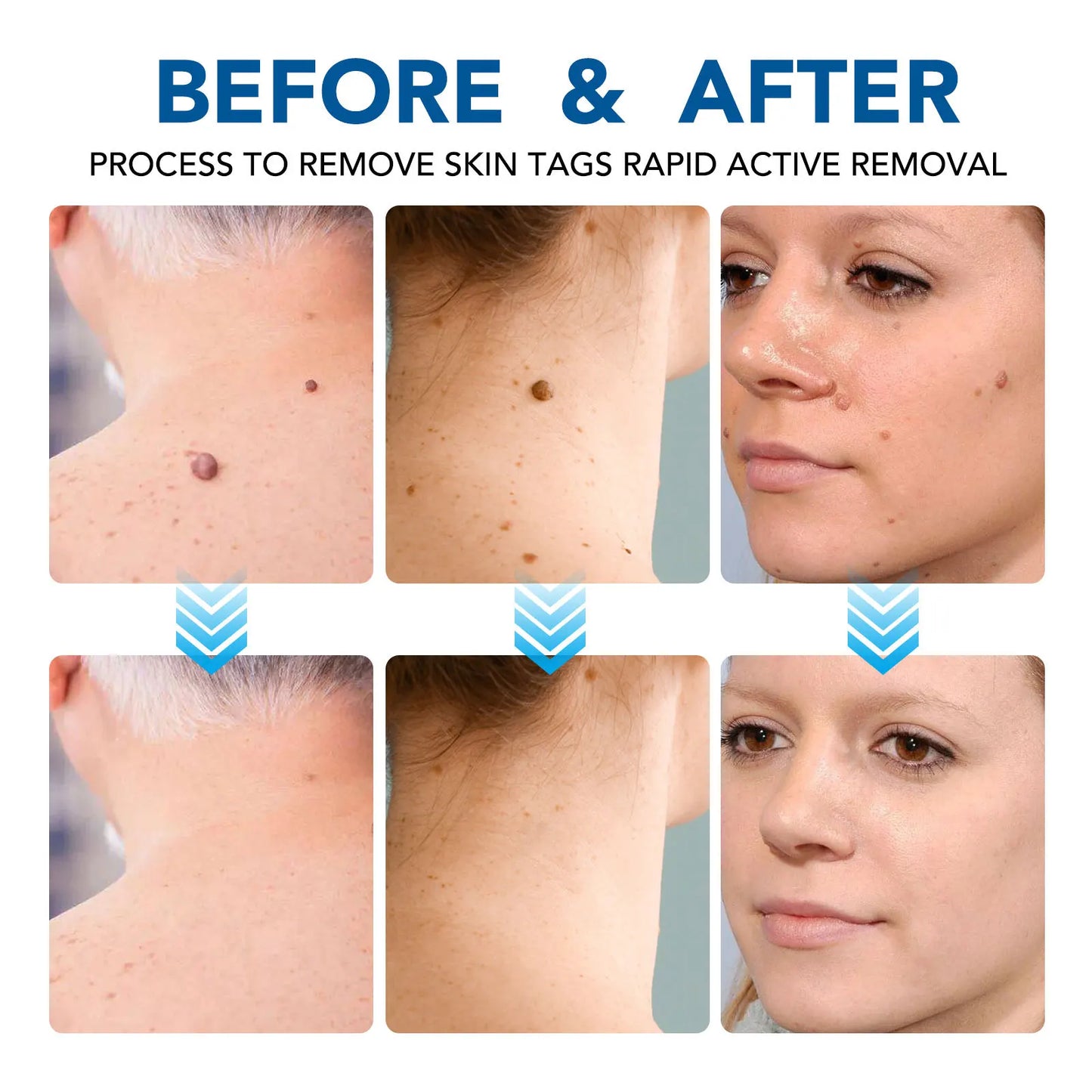 Skin Tag Removal Mole Wart Removal Facial Mole Wart Microstrip Tag Removal Kit Automatic Mole Remover Tool with Cleansing Swabs