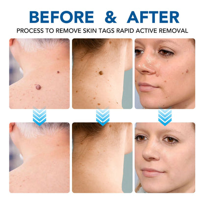 Skin Tag Removal Mole Wart Removal Facial Mole Wart Microstrip Tag Removal Kit Automatic Mole Remover Tool with Cleansing Swabs