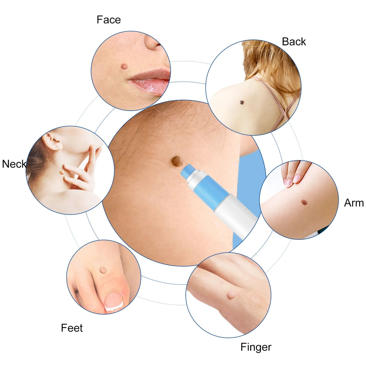 Skin Tag Removal Mole Wart Removal Facial Mole Wart Microstrip Tag Removal Kit Automatic Mole Remover Tool with Cleansing Swabs