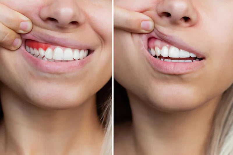 Gingival repair drops Quickly Repair of Cavities Caries Teeth Whiten Remove Yellow Plaque Stains Relieve Gums Decay Toothpaste