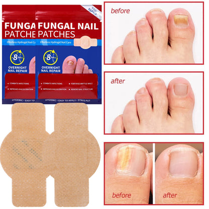 21pcs Nail Fungus Patch Waterproof Nail Repair Patch Ingrown Correction Sticker Damaged Nail Gray Care Patch Feet Care Tools