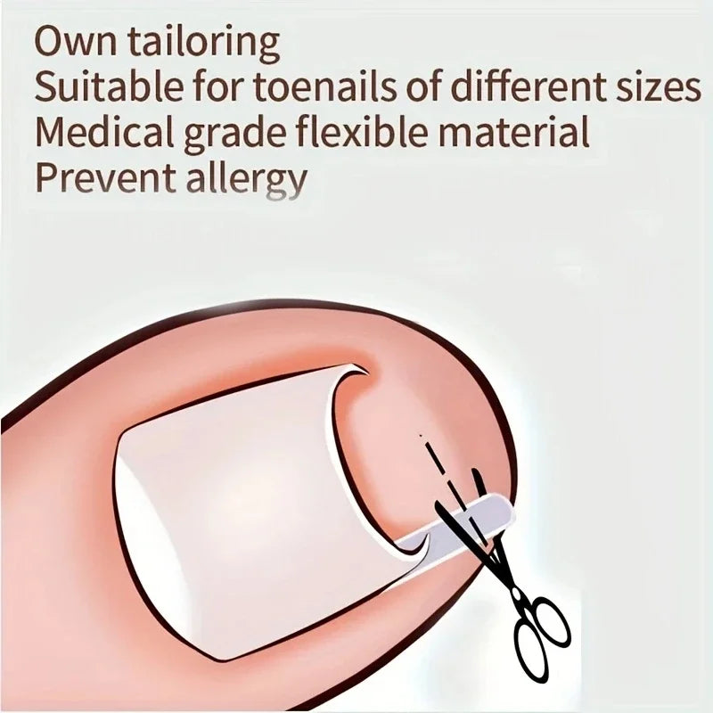 50Pcs Ingrown Toenail Correction Tool Invisible Ingrown Toe Nail Treatment Pad Groove Straightening Clip Brace Foot Care Tool
