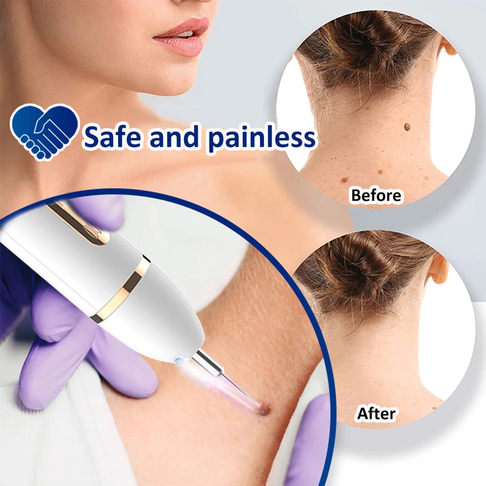 Laser Plasma Pen Remover Facial Mole Skin Tag Dark Spot Rechargeable Plasma Pen Warts Nevus Tattoo Freckle Papilloma Removal