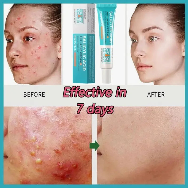 Salicylic Acid Acne Treatment Cream – Anti-Acne & Pimple Scar Repair Gel, Shrink Pores, Moisturizing & Smoothing Skin Care