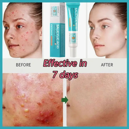 Salicylic Acid Acne Treatment Cream – Anti-Acne & Pimple Scar Repair Gel, Shrink Pores, Moisturizing & Smoothing Skin Care