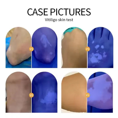 NEW Woods Lamp Skin Analyzer Portable Facial Salon Beauty Analyzer UV Lamp Wood Dermatology for Analyzing Testing Examination