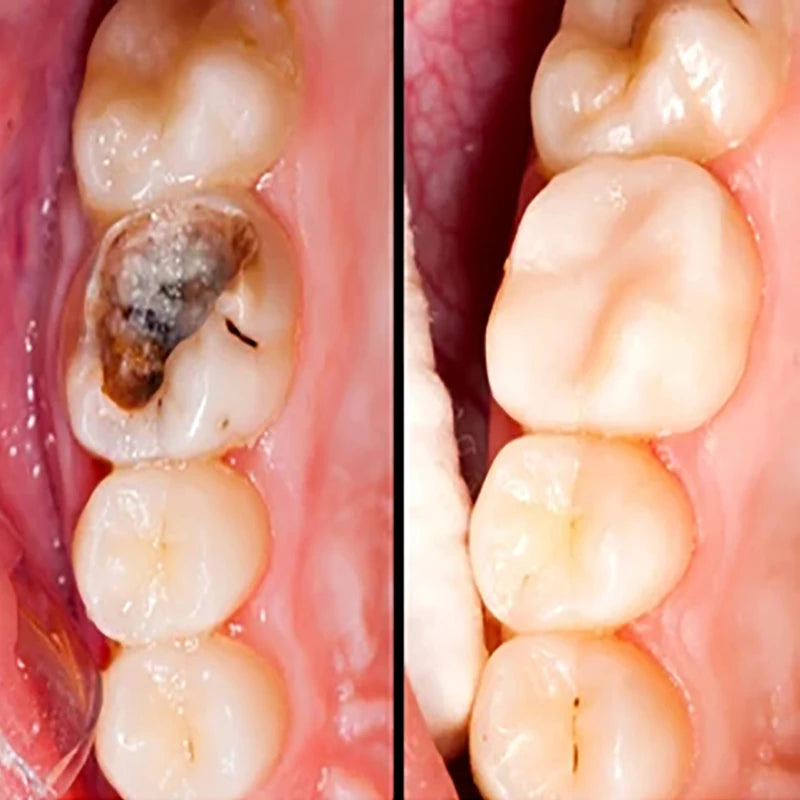 Gingival repair drops Quickly Repair of Cavities Caries Teeth Whiten Remove Yellow Plaque Stains Relieve Gums Decay Toothpaste