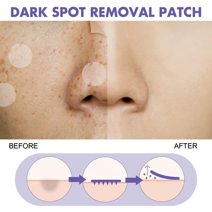 Spot-removing patches - for lightening facial dark spots, chloasma, pigmentation andmelanin; moisturizing skin. spot patches