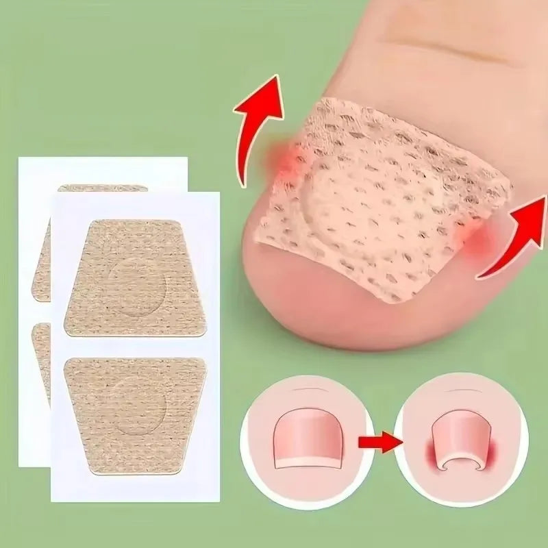 Nail Repair Patch Grey Fungal Nails Thickening Soft Paronychia Treatment Anti Infection Correction Sticker Ingrown Toenail Care